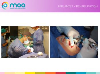 moa-dental-implantes-y-rehabilitación-3