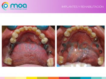 moa-dental-implantes-y-rehabilitación-4