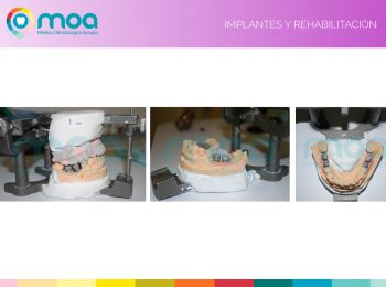 moa-dental-implantes-y-rehabilitación-5