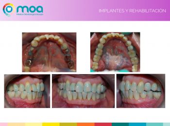 moa-dental-implantes-y-rehabilitacion-6