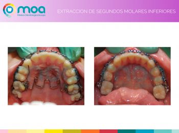 moa-dental-prognatismo-mandibular-10