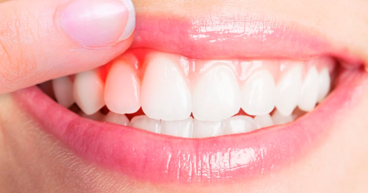 Periodoncia - Clínica Dental En Coapa