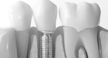 Implantes dentales | Dentista en Villa Coapa