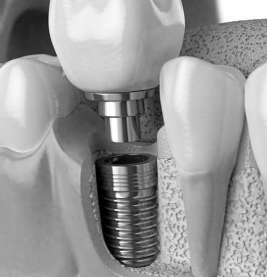 Descripción de Implantes Dentales